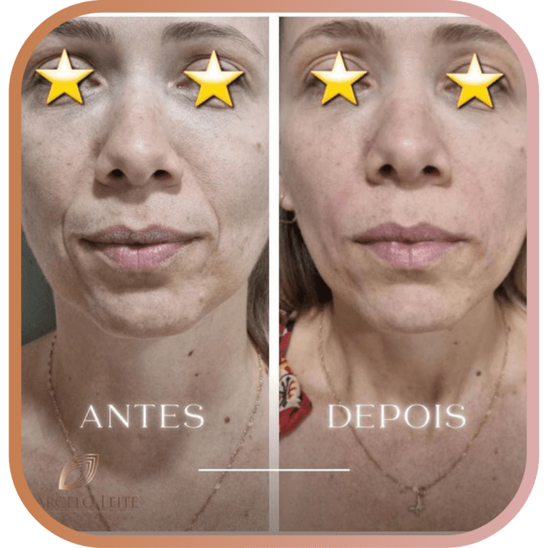 Resultados dos tratamentos de estética